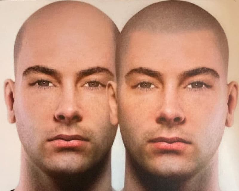 Before and after picture of bald man with scalp micropigmentation