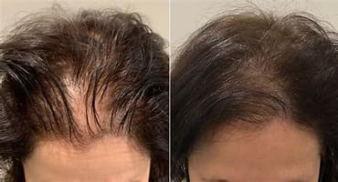 Before and after picture of woman with bald area fixed by scalp micropigmentation